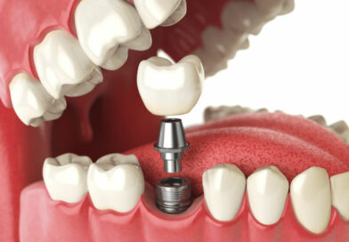 What You Should Pay for Dental Implants What You Should Pay for Dental Implants