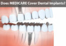 Dental Implants by Medicare for Seniors Dental Implants by Medicare for Seniors