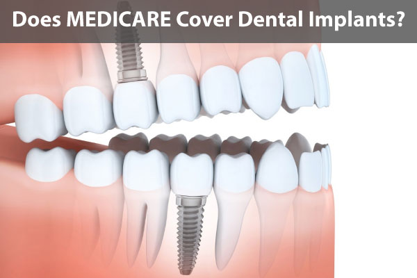 dental-implants-by-medicare-for-seniors-all-services